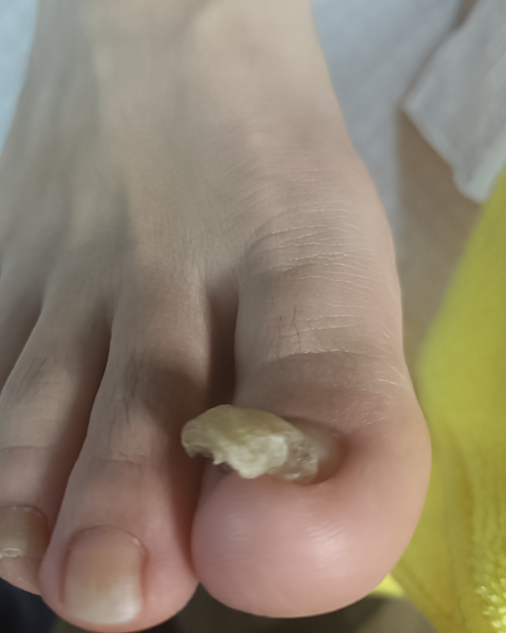 【足の爪が分厚くて切れない…】それ、「肥厚爪（ひこうづめ）」かも？痛くないプロのケアで、つるつるの爪を取り戻しましょう！