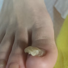 【足の爪が分厚くて切れない…】それ、「肥厚爪（ひこうづめ）」かも？痛くないプロのケアで、つるつるの爪を取り戻しましょう！
